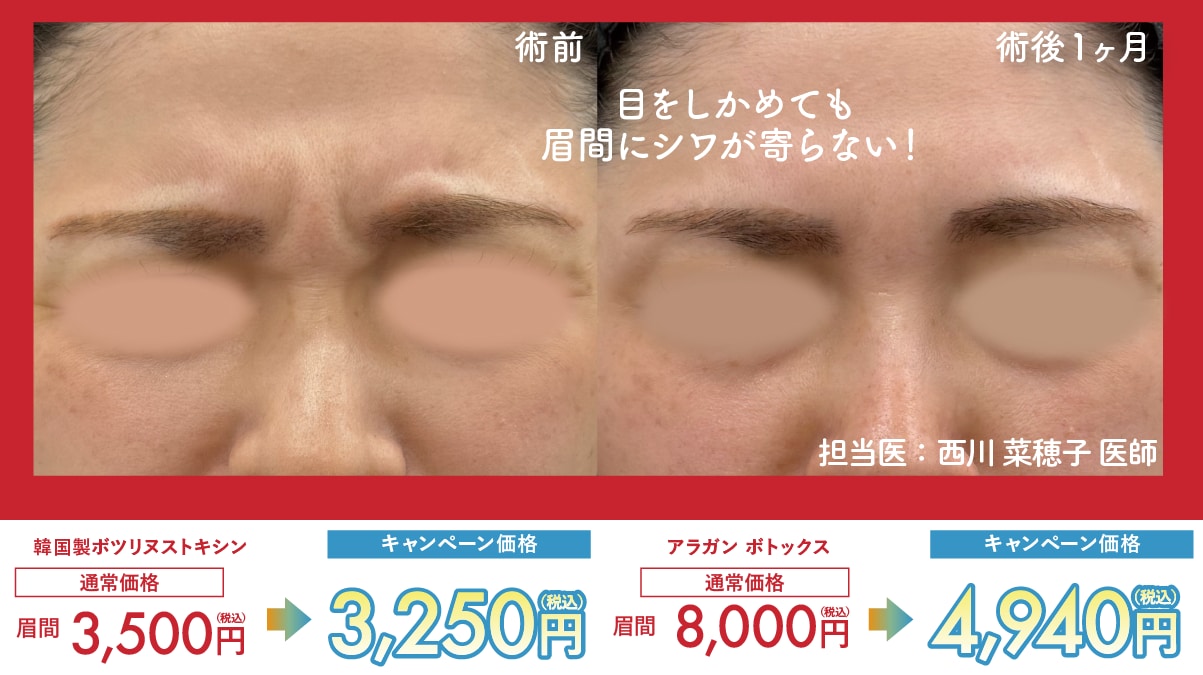 眉間のシワ取り注射