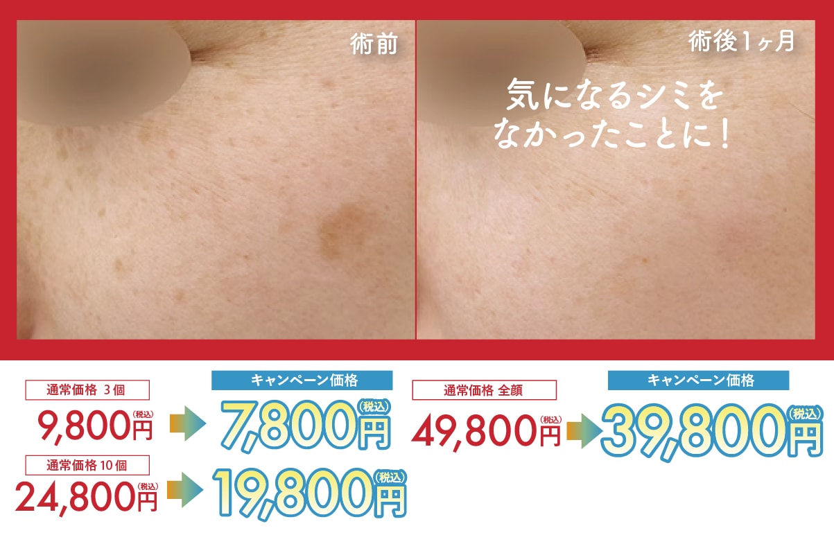 シミ取りレーザー