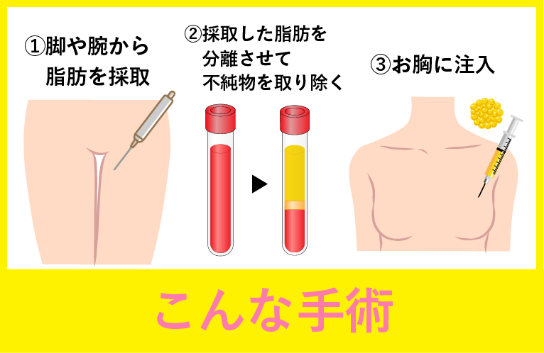 SBCリッチ豊胸ってどんな手術？