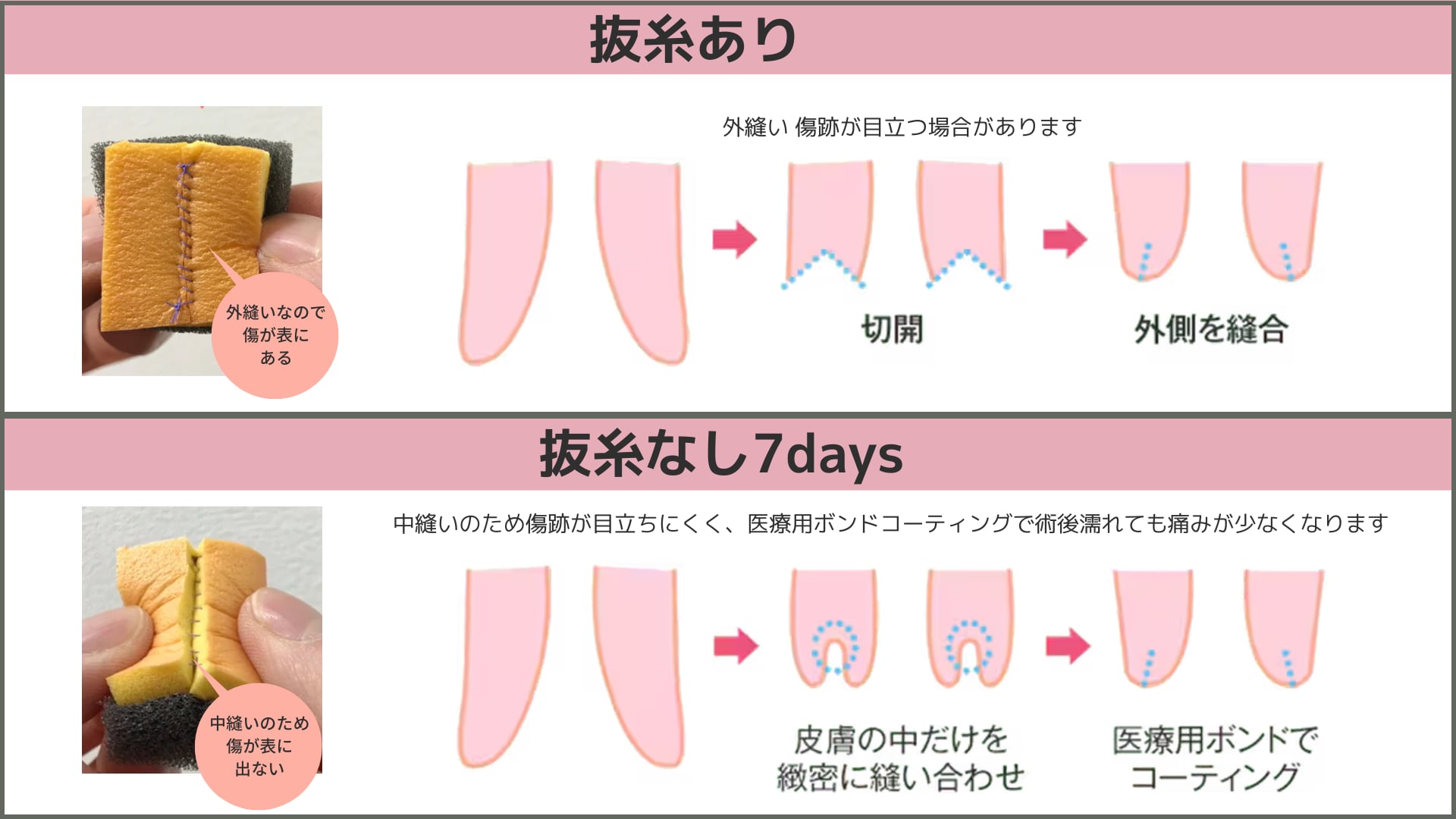 奈々先生おすすめの「抜糸なし7days法」