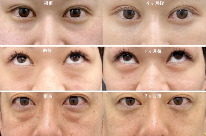 名取副院長の裏ハムラ法 症例写真