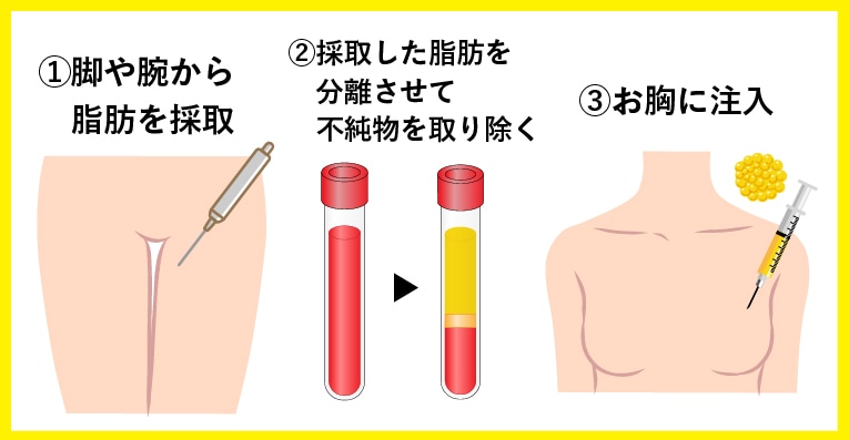 SBCリッチ豊胸 施術の流れ