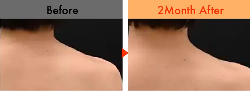 肩ボトックス 症例写真2