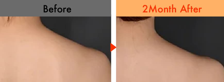肩ボトックス 症例写真1