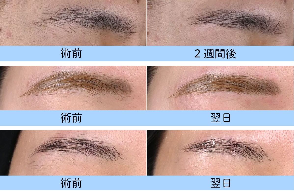 ニードル脱毛 症例写真