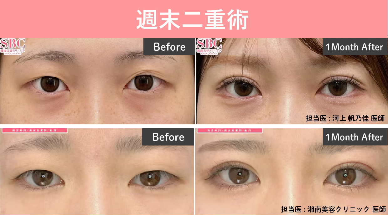 週末二重術