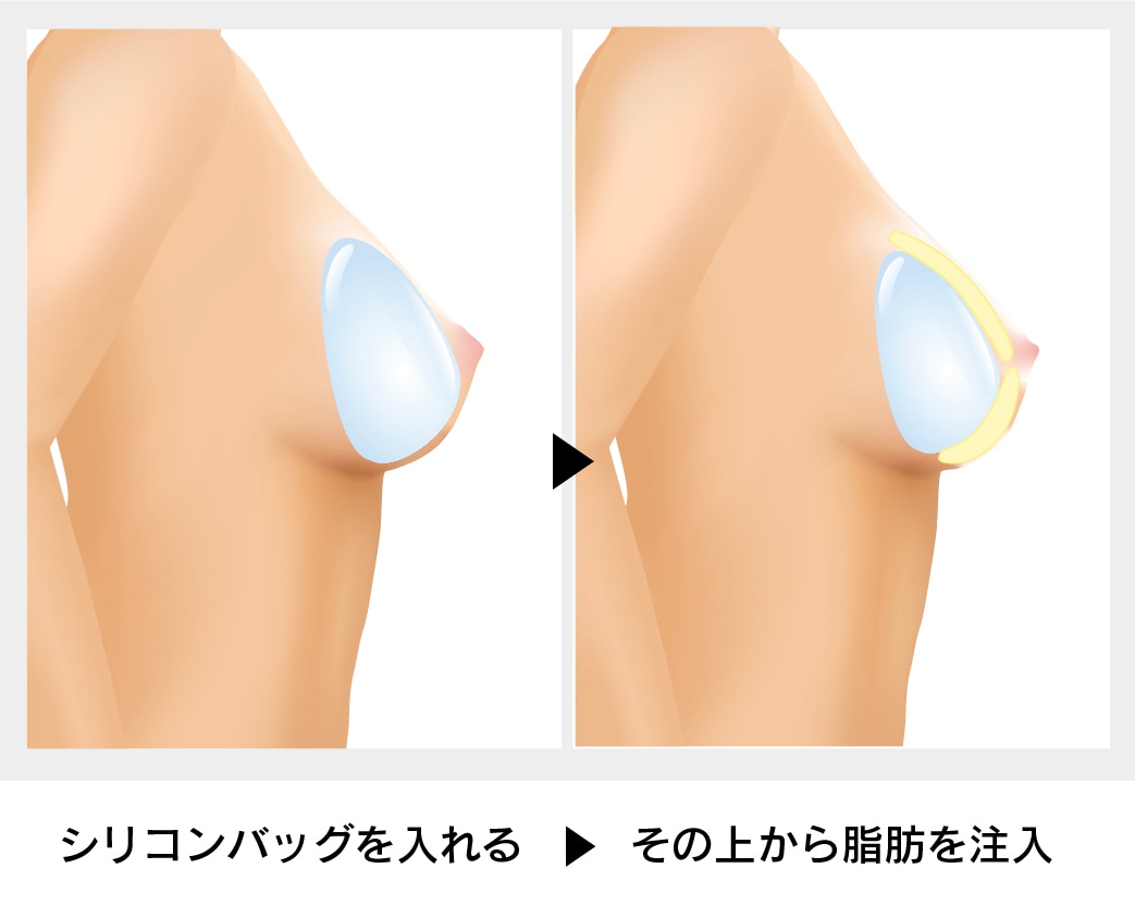 ハイブリッド豊胸 説明