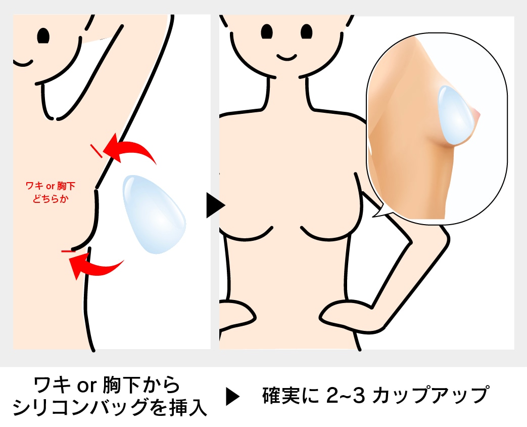 シリコンバッグ豊胸 説明