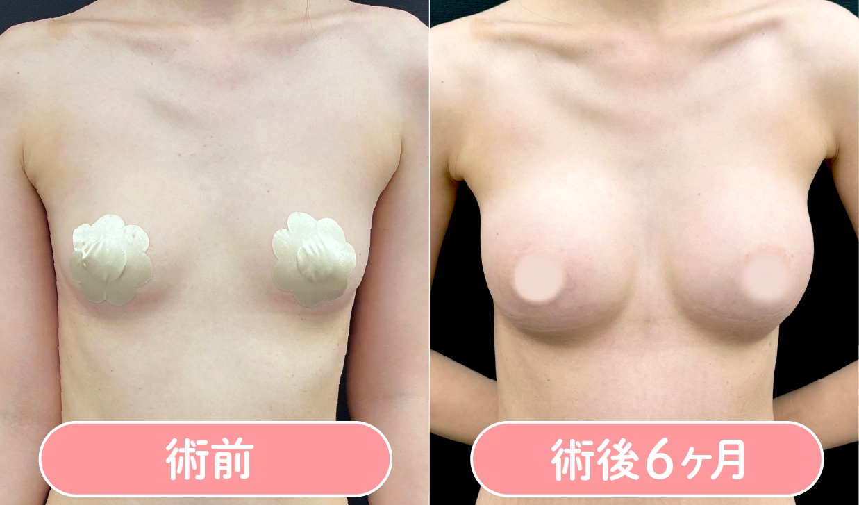 シリコンバッグ豊胸 症例写真1