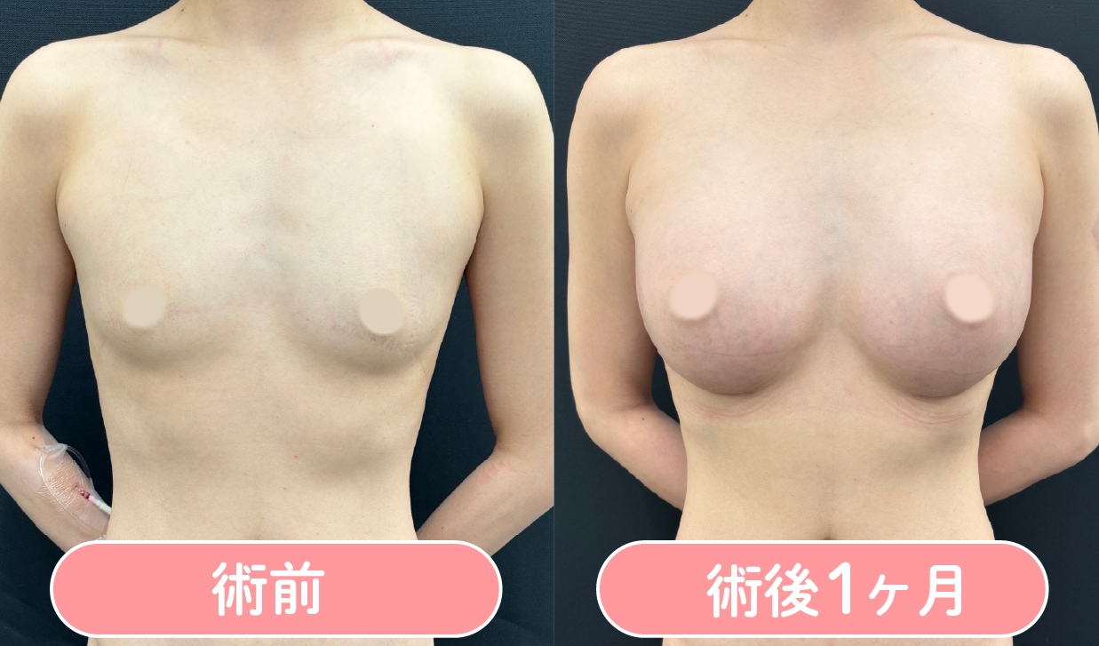 ハイブリッド豊胸 症例写真2