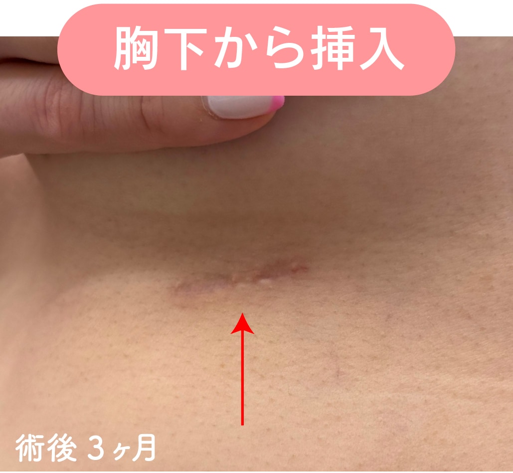 シリコンバッグ豊胸 胸下傷跡