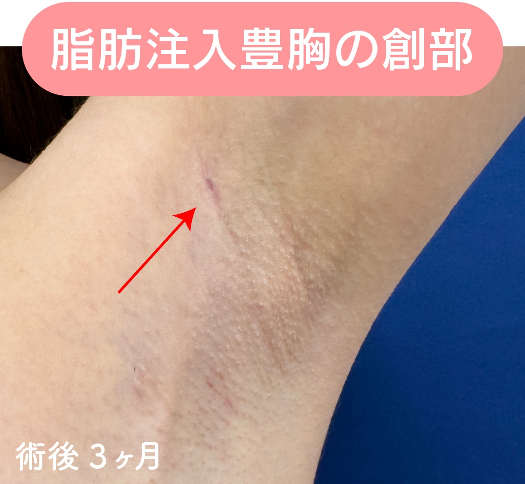 脂肪注入豊胸 傷跡