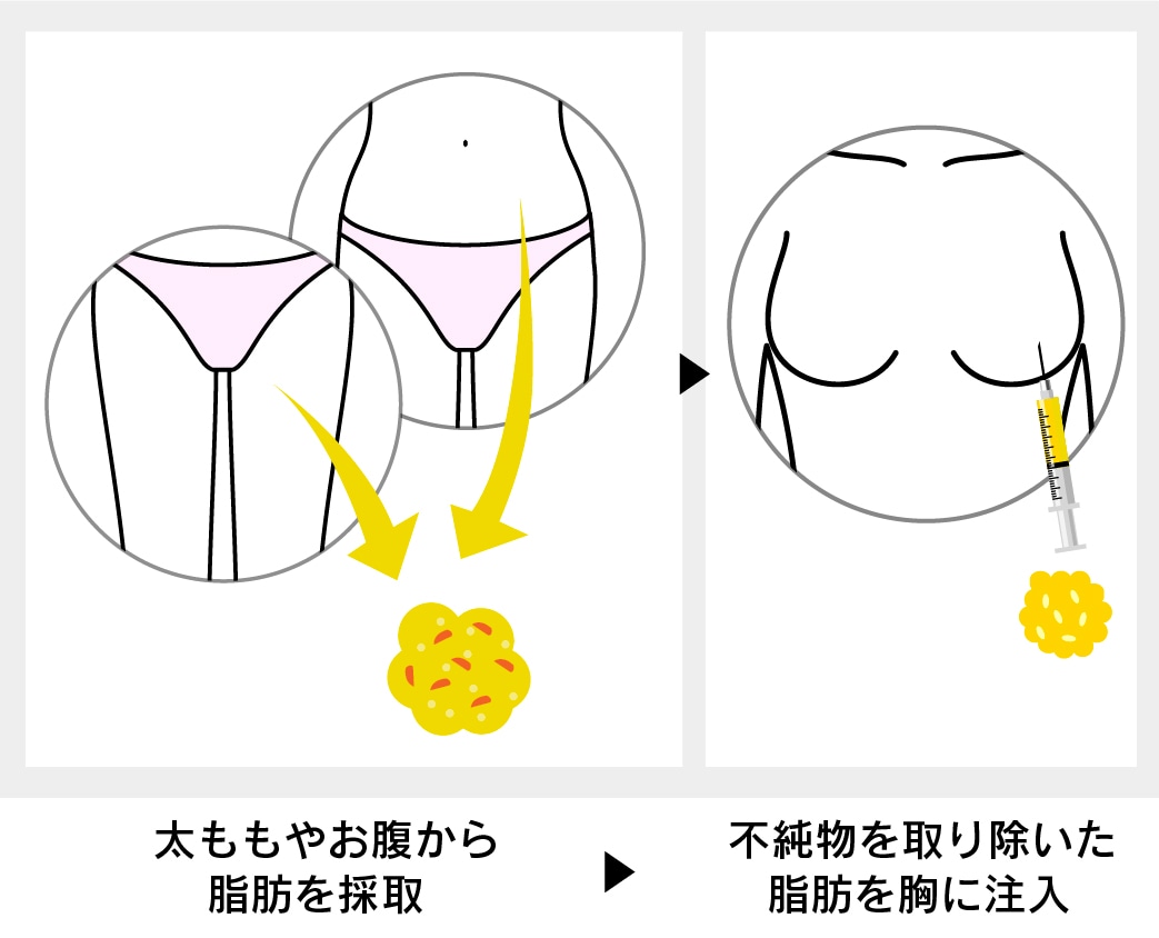 脂肪注入豊胸 説明