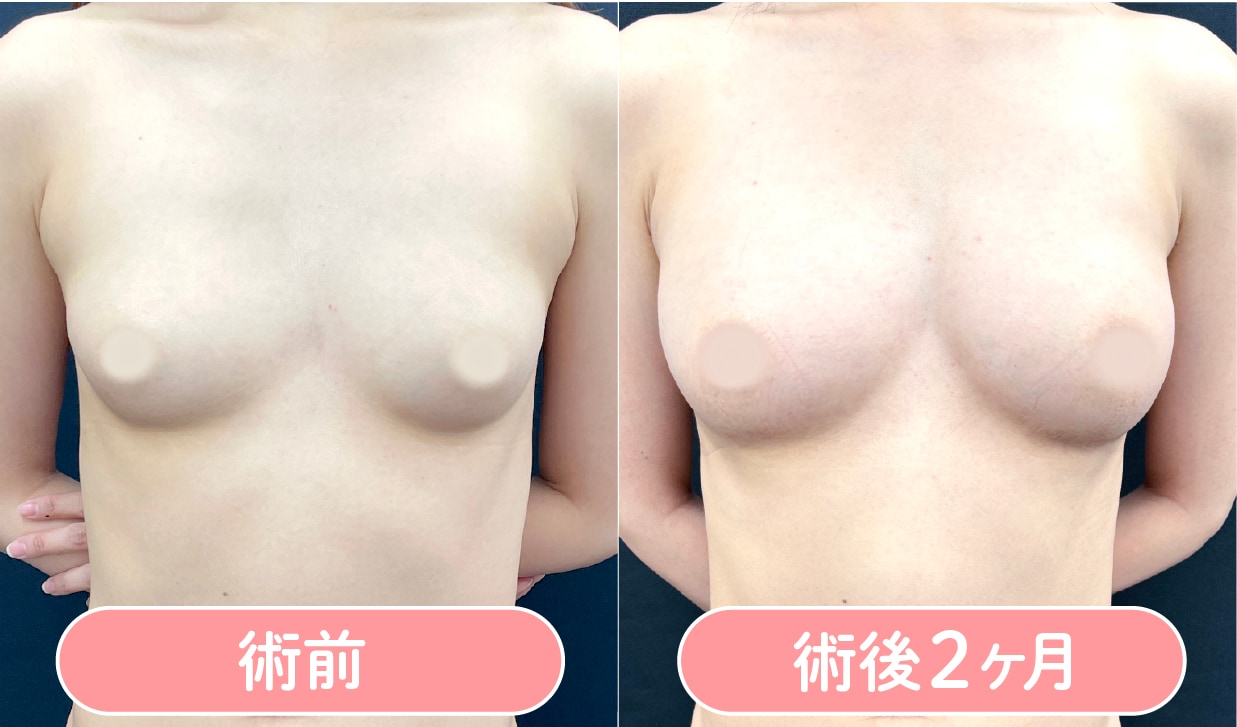脂肪注入豊胸 症例写真1