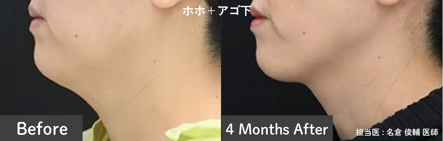 脂肪吸引注射