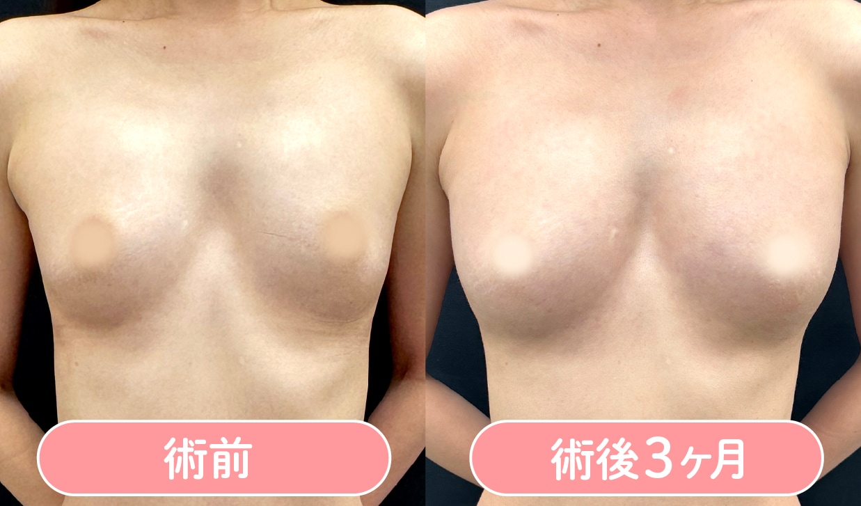 脂肪注入豊胸 症例写真2