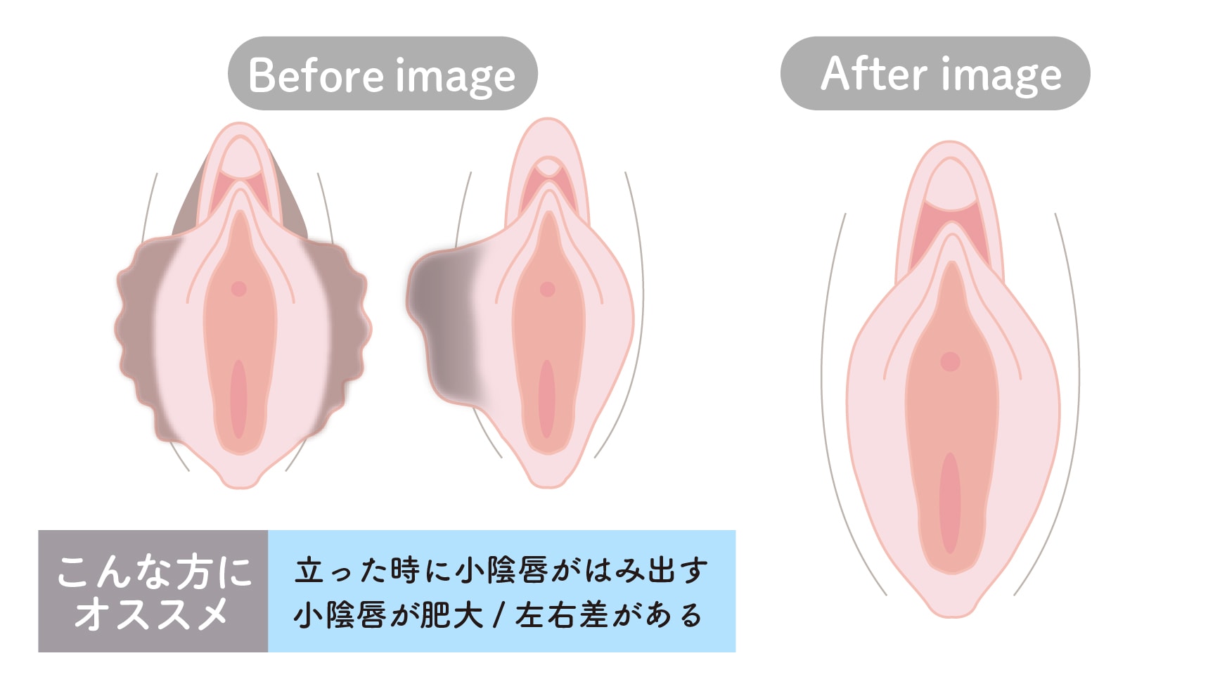 小陰唇縮小術