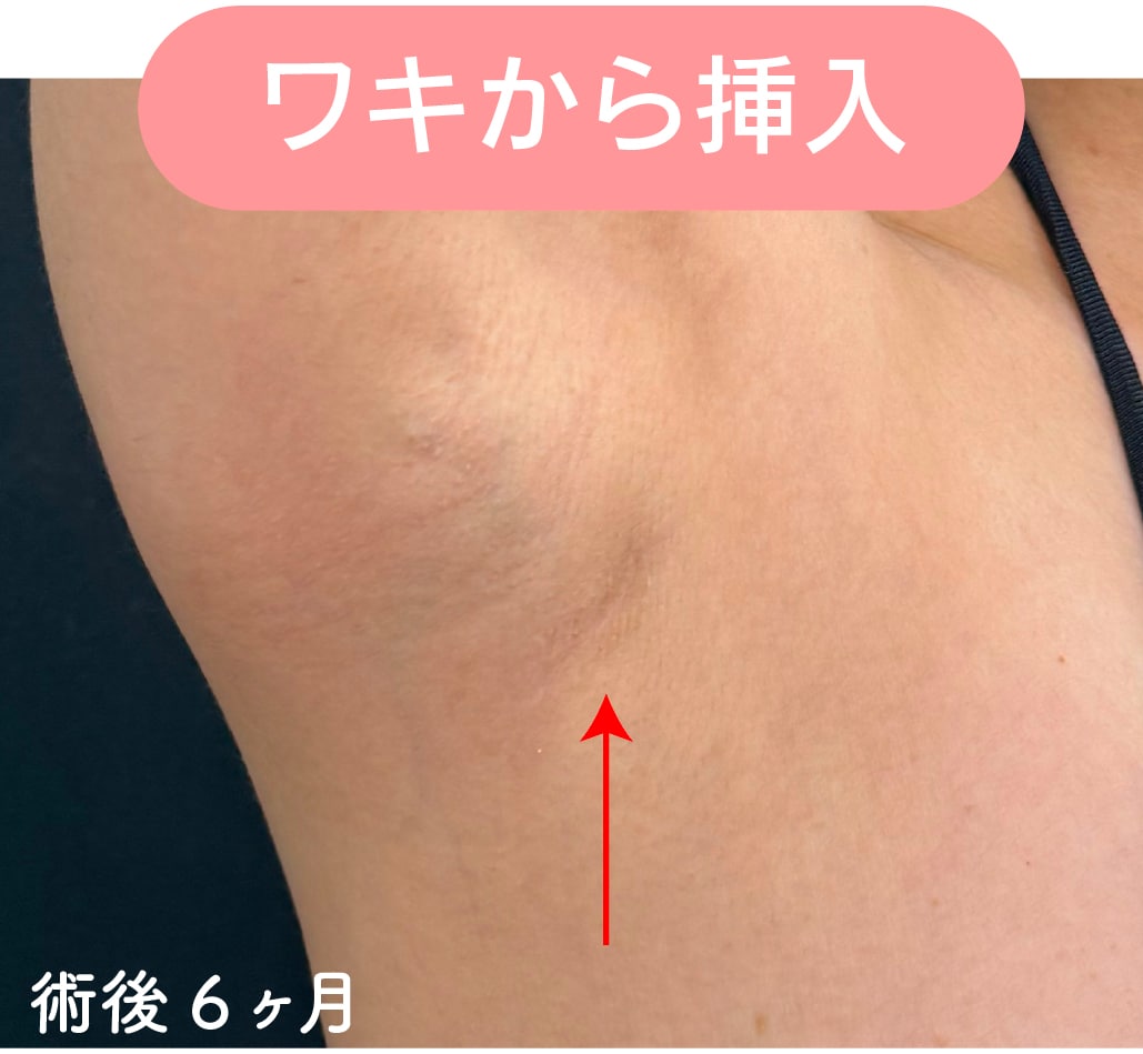 シリコンバッグ豊胸 ワキ傷跡