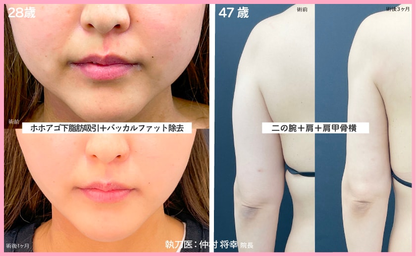 脂肪吸引