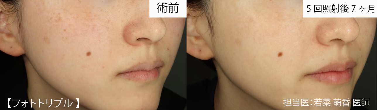 IPL光治療 症例写真