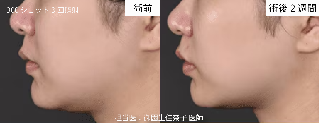 リニアハイフ 症例写真