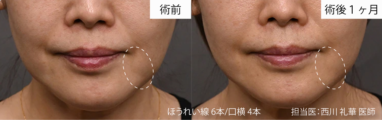 ぽにょぴたスレッド 症例写真