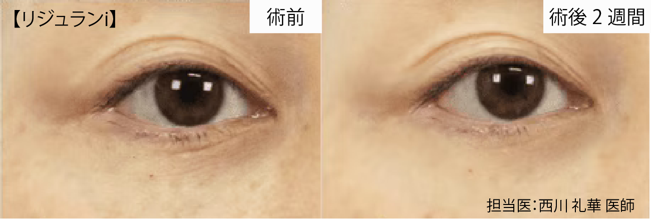 リジュラン 症例写真