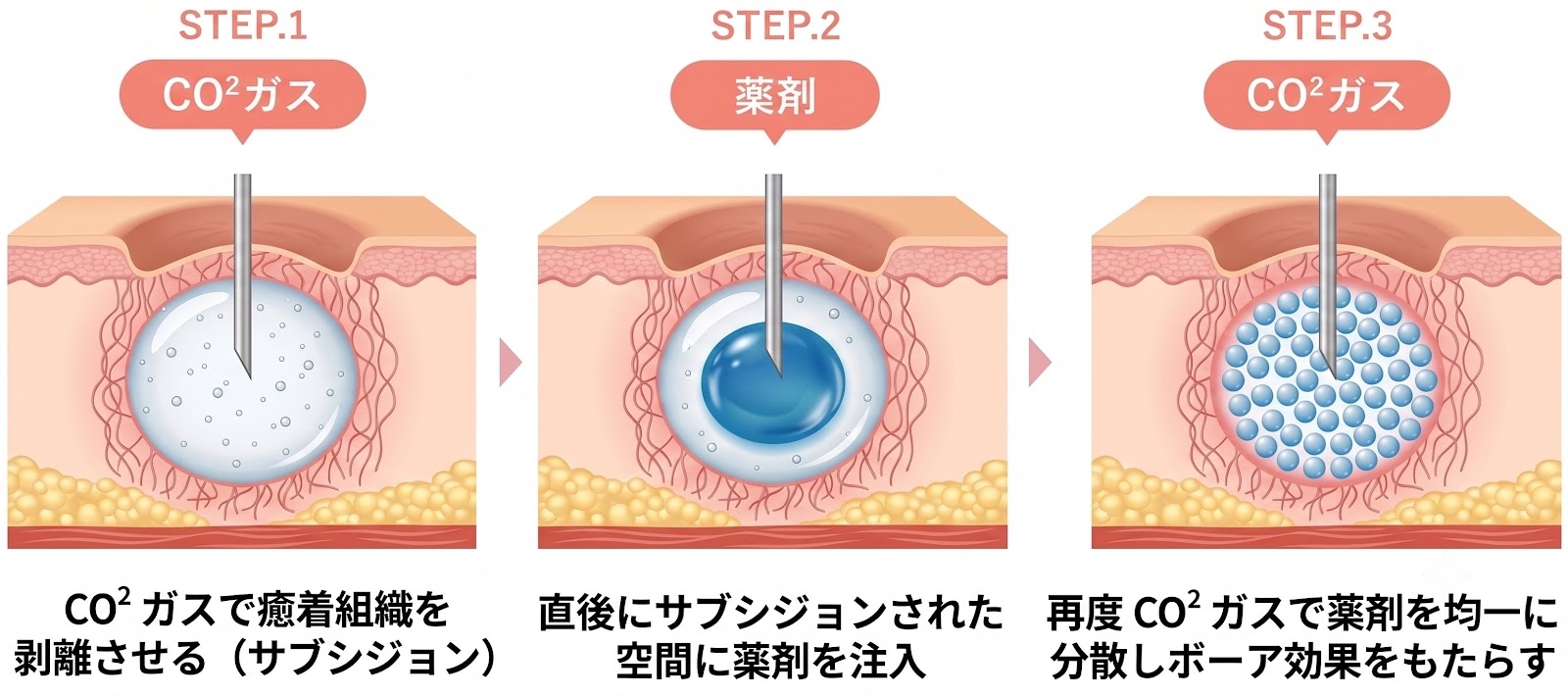 トライフィルプロの仕組みメカニズム