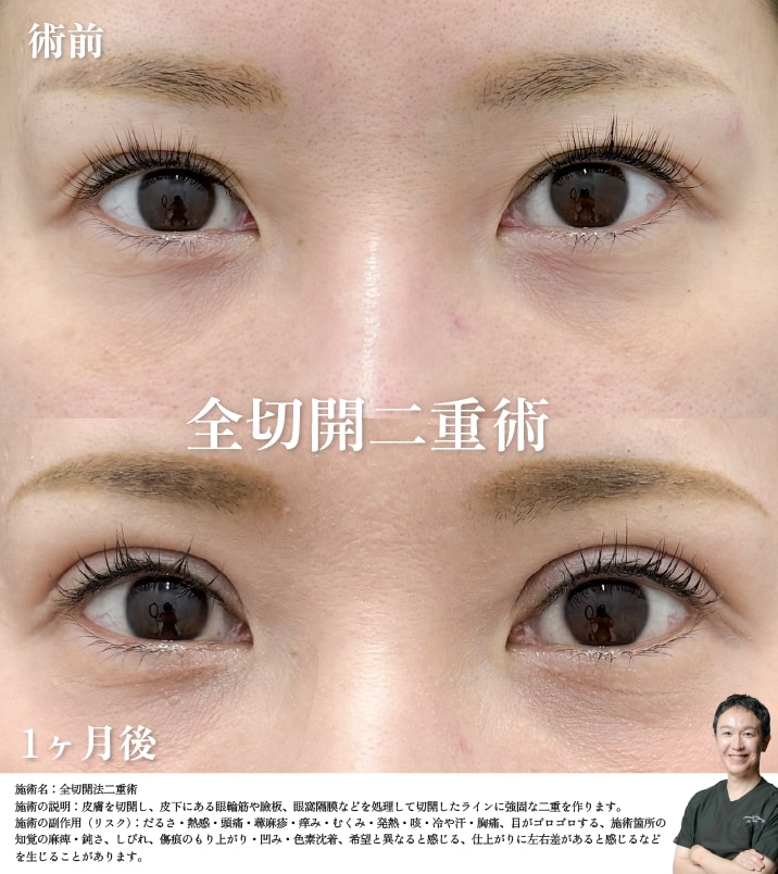 全切開法二重術 症例写真