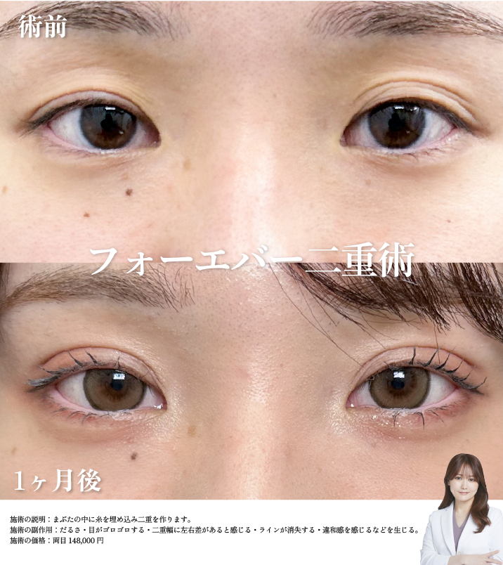 フォーエバー二重術 症例写真2