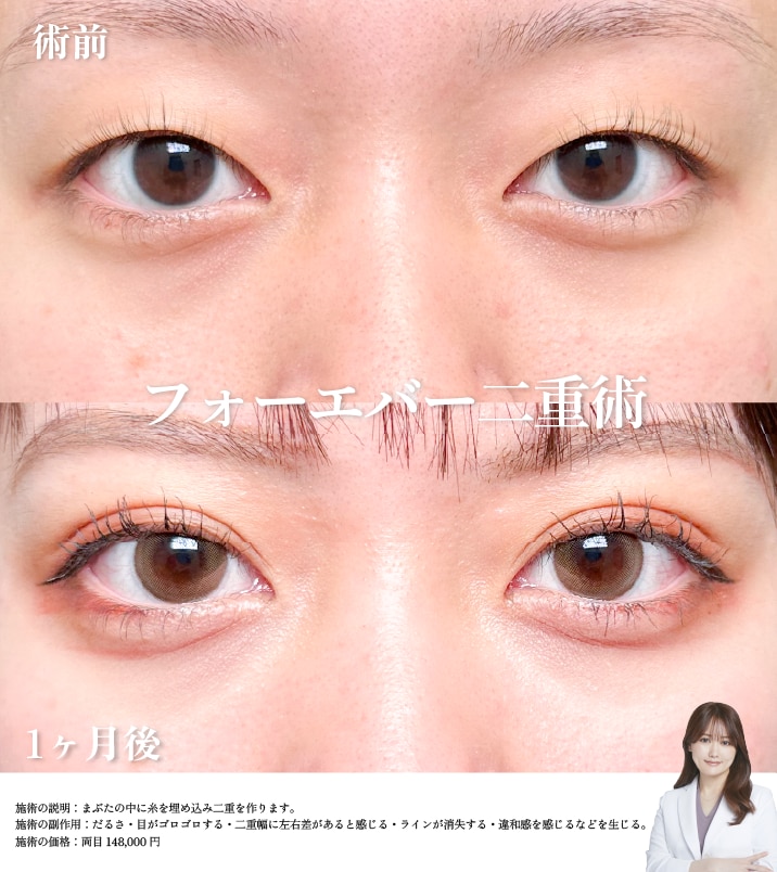 フォーエバー二重術 症例写真1