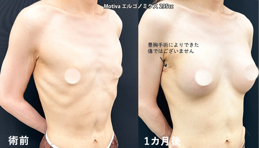 仲村院長 男性豊胸症例2