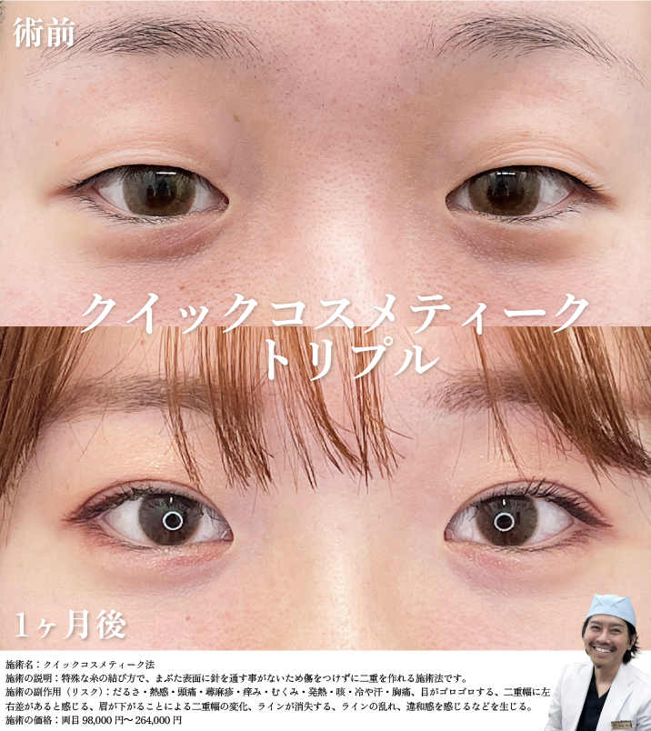 クイックコスメティーク・トリプル 症例写真