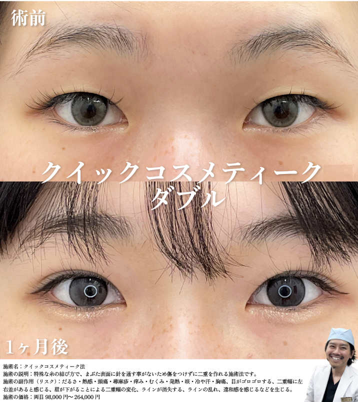 クイックコスメティーク・ダブル 症例写真