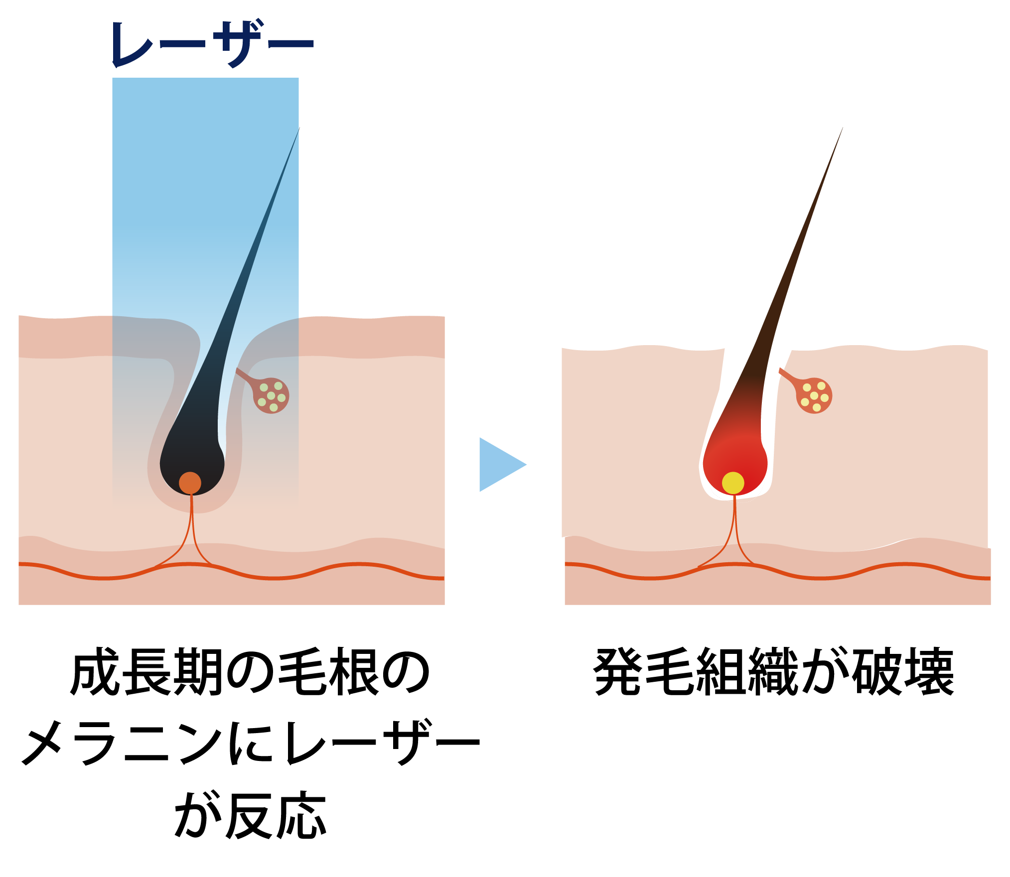 医療脱毛の仕組み 皮膚断面図