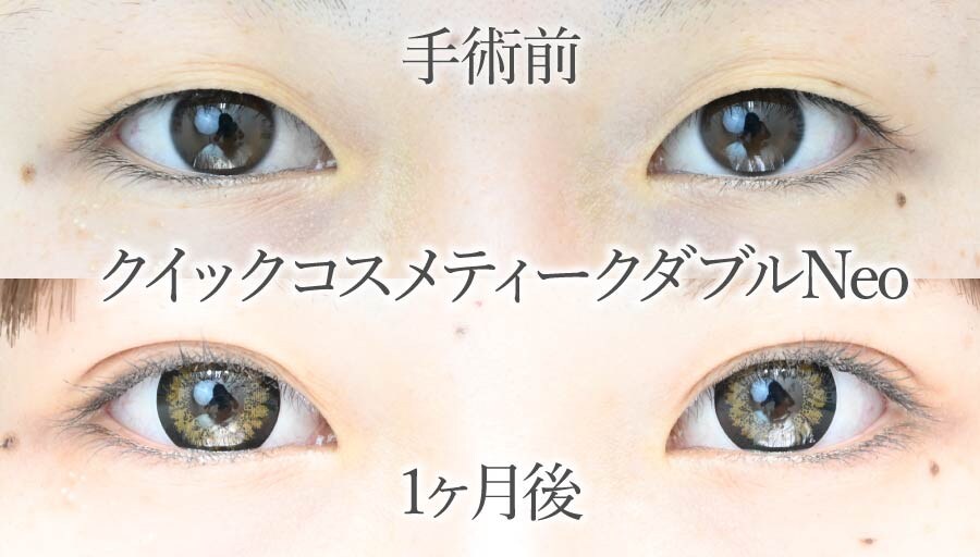 二重にする