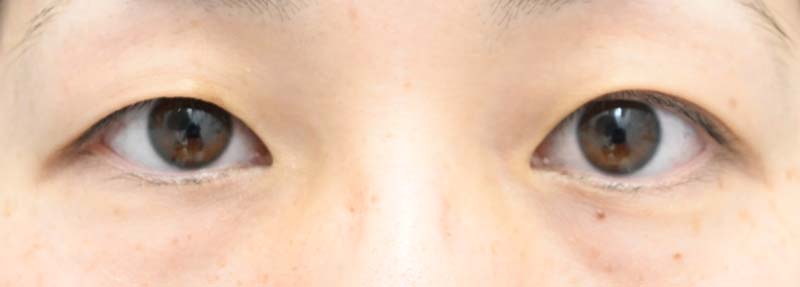 【目を大きく魅せる二重が得意】井上礎馬のサークルアイ二重
