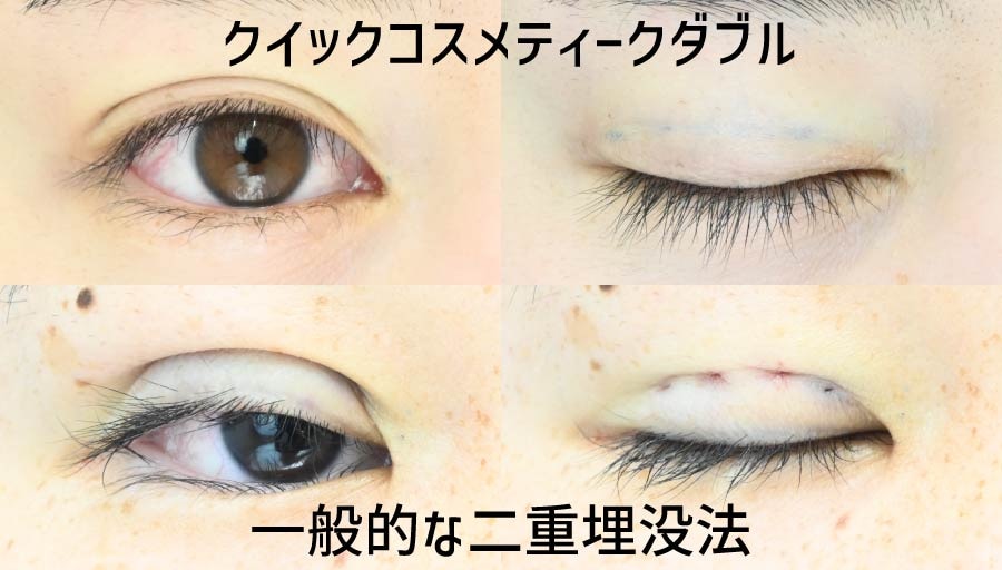 他の二重埋没法とも比較してみた！