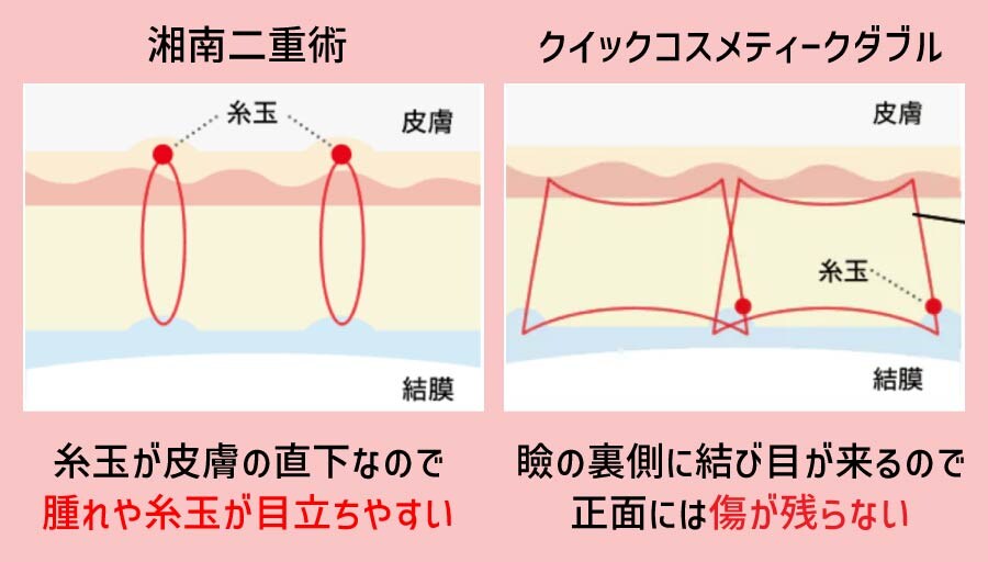 腫れの違いは術式にある
