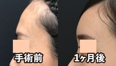 【番外編】別のスタッフS、額こめかみにも脂肪注入してみた!