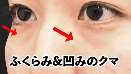 治療前の目のクマ