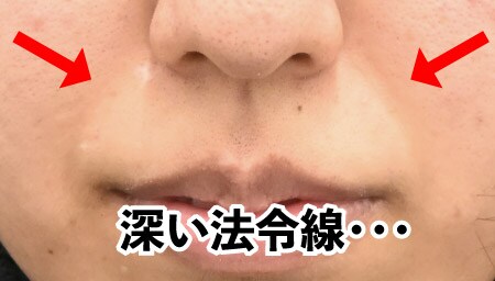 治療前の法令線