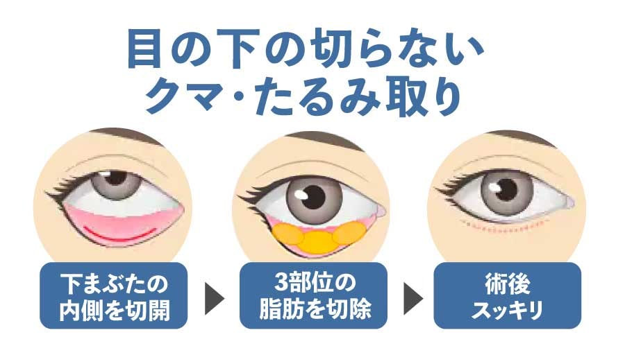 目の下の切らないクマ・たるみ取り