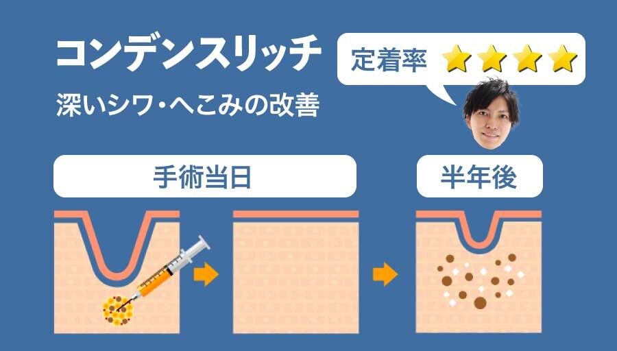 コンデンスリッチ脂肪注入