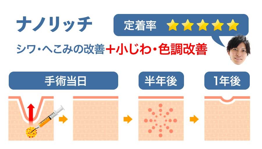 ナノリッチ脂肪注入