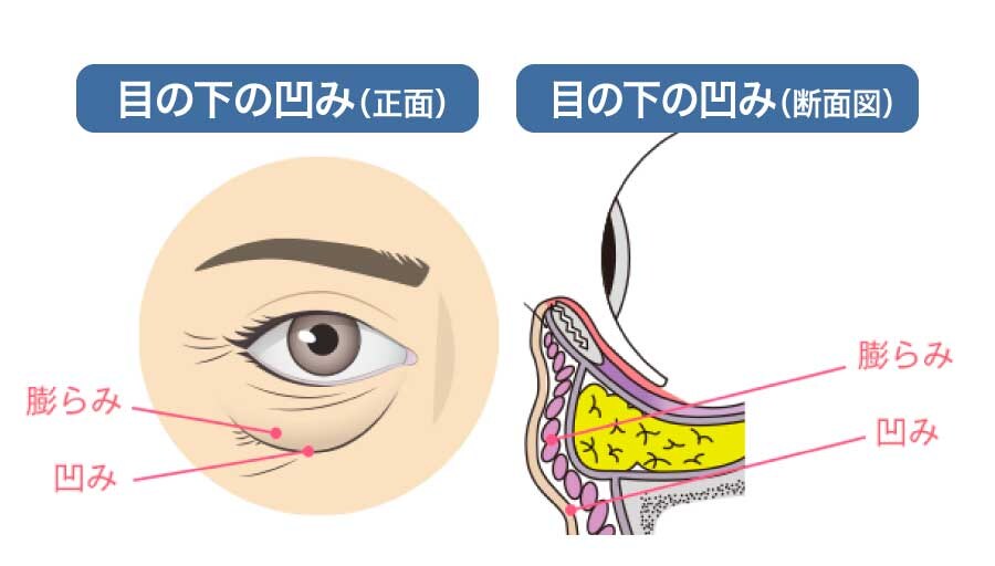 目の下の切らないクマ・たるみ取り+ナノリッチ脂肪注入(目の下)+コンデンスリッチ脂肪注入(目の下〜ゴルゴ線)