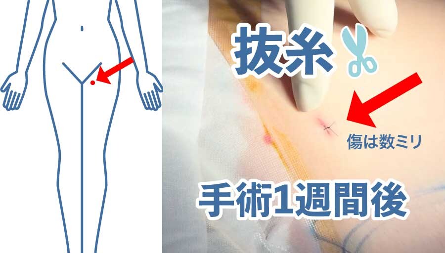抜糸