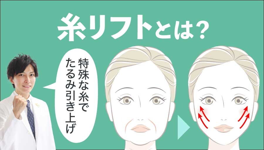 糸リフトとは