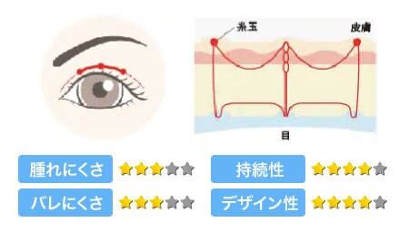 フォーエバー二重術