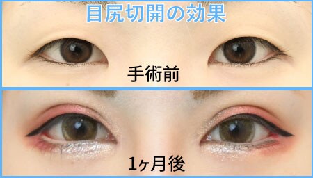 つり目が気になるなら目尻切開